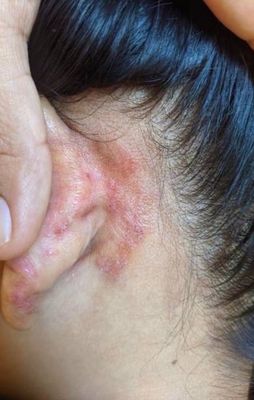 Permimite lotion 2 pcs & scrabic soap 1 pcs_img_8