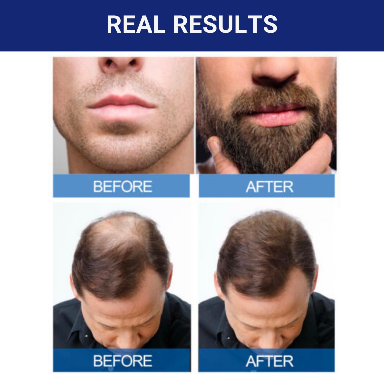 Kirkland Minoxidil 5% For Beard & Hair Growth (One Month Supply/Six Months Supply) Made in USA_img_4
