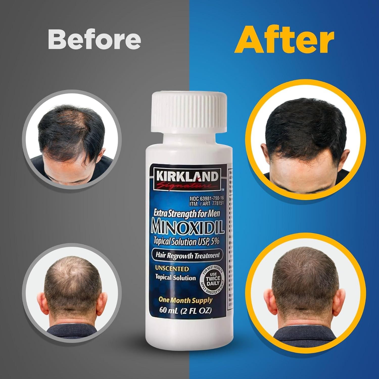 Kirkland Minoxidil 5% For Beard & Hair Growth (One Month Supply/Six Months Supply) Made in USA_img_0