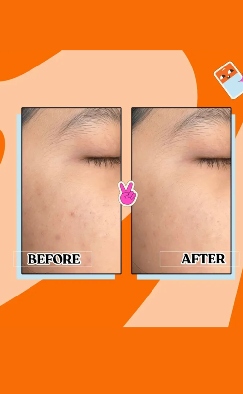 Dermo-U Anti-Acne Patch – Pink Heart - Image 4