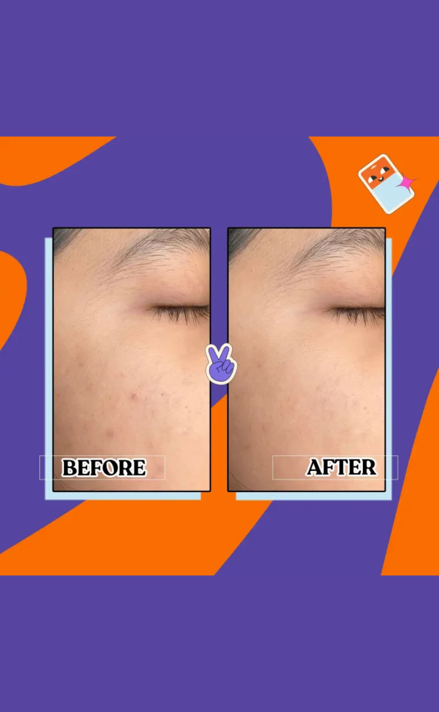 Dermo-U Anti-Acne Patch – Purple Star - Image 5