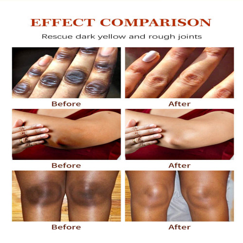 Skin Care Whitening Beauty Serum for Elbow and Knee (CHINA)_img_1