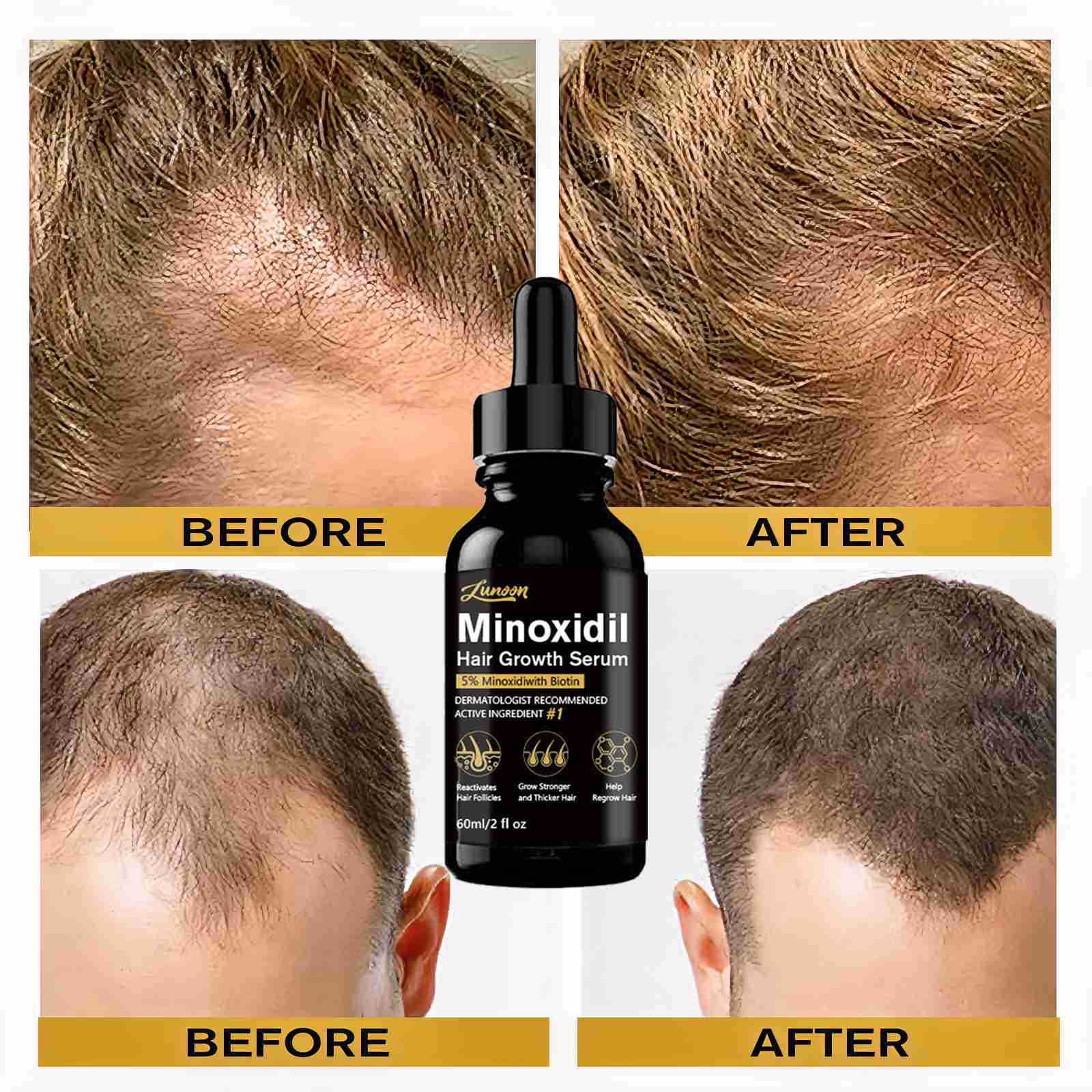 LUNOON Minoxidil 5% for Men Hair, Minoxidil Hair Growth Serum_img_1