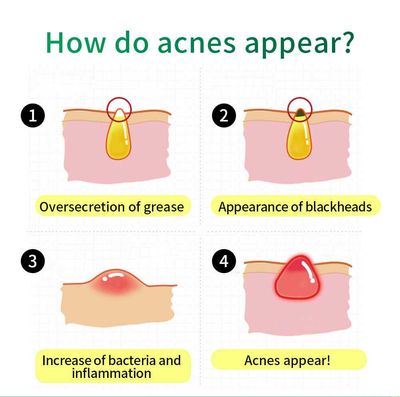 Breylee acne treatment cream_img_1