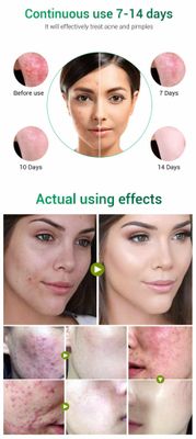 Breylee acne treatment cream_img_2