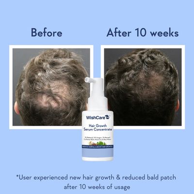 Hair Growth Serum Concentrate With 3% Redensyl, 4% Anagain, Rice Water, Biotin._img_2