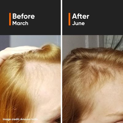 Minimalist Hair Growth Serum – 18% Actives with Redensyl, Anagain, Procapil, Capixyl & Baicapil_img_2