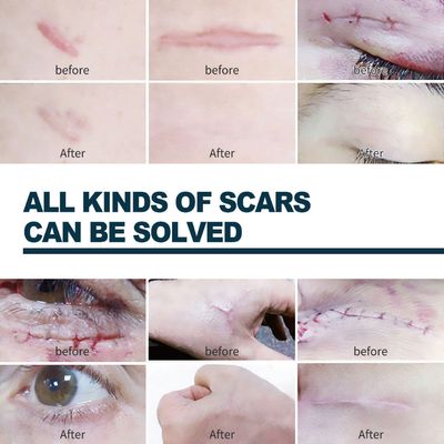 Silicone Gel Scar Patch Roll – Adjustable, Effective Scar Treatment_img_9