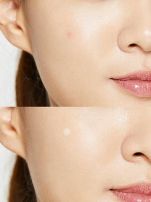 Cosrx Acne Pimple Master Patch 24's Pack_img_3