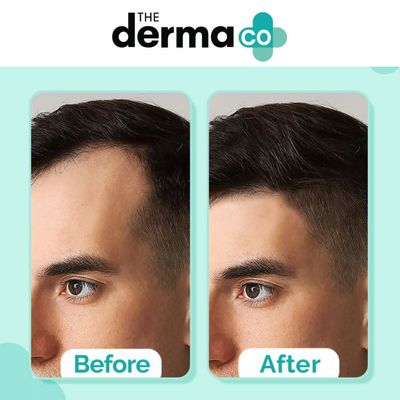 The Derma co 20% Actives Peptide-Stem Cell Hair Growth Serum with Foligen Analupe & Anagain For Hair Growth - 30 ml_img_3