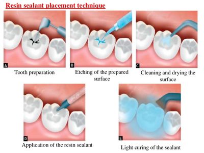 pits and fissure sealant_img_1
