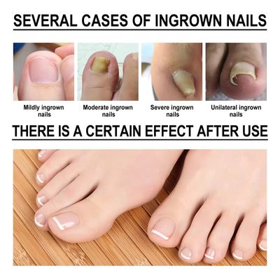 Toenail Pain Relief Kit and Fabric Softener 10ml_img_1