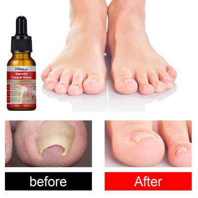 Toenail Pain Relief Kit and Fabric Softener 10ml_img_4