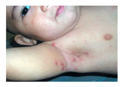 Scrabic Lotion 100ml [ Indian ] শিশু ও প্রাপ্তবয়স্কের জন্য_img_4