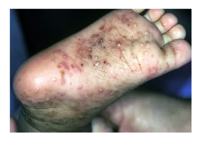 Scrabic Lotion 100ml [ Indian ] শিশু ও প্রাপ্তবয়স্কের জন্য_img_5