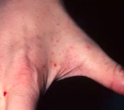 Scrabic Lotion 100ml [ Indian ] শিশু ও প্রাপ্তবয়স্কের জন্য_img_6