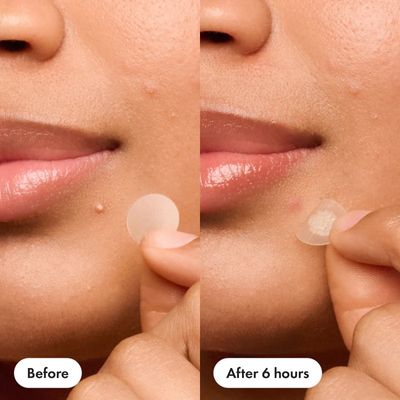 Mighty Patch Original 36pcs Pimple Patch_img_6