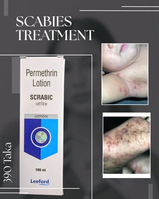 Scrabic Lotion 100ml [ Indian ] শিশু ও প্রাপ্তবয়স্কের জন্য_img_0