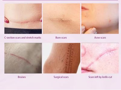Ouhoe Scar Removing Cream (50g)_img_1