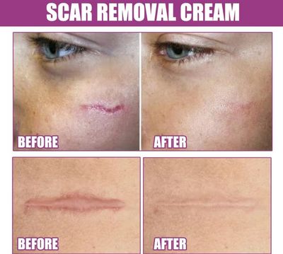 Ouhoe Scar Removing Cream (50g)_img_2