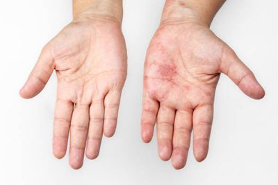 Scrabel Permethrin Soap [Indian] চুলকানি চিকিৎসায়_img_7