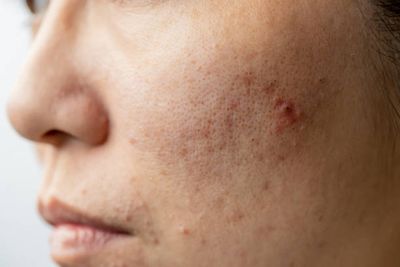 Acnetoin [Indian] Anti Acne Soap ( ব্রণের চিকিৎসায়)_img_6