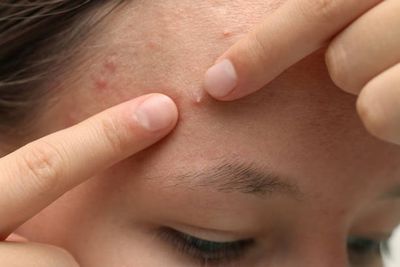 Acnetoin [Indian] Anti Acne Soap ( ব্রণের চিকিৎসায়)_img_7