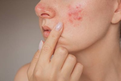 Acnetoin [Indian] Anti Acne Soap ( ব্রণের চিকিৎসায়)_img_8