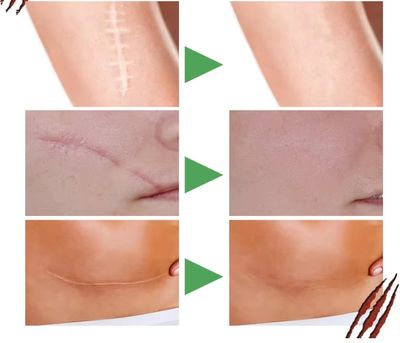 Ouhoe Scar Removal Serum 30 ml_img_2