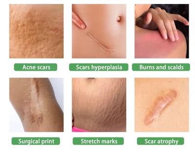 Ouhoe Scar Removal Serum 30 ml_img_0