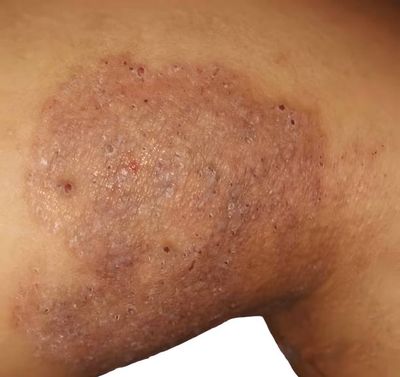 Derobin Ointment 30 gm [Indian]_img_4