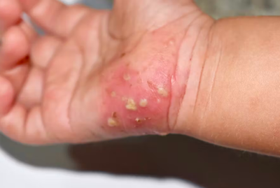 Scrabic Lotion - শিশুদের চুলকানি ধ্বংসকারী লোশন [ Indian ]_img_5