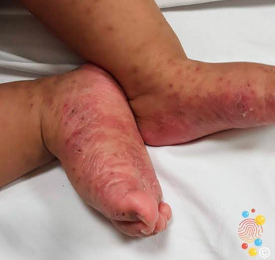 Scrabic Lotion - শিশুদের চুলকানি ধ্বংসকারী লোশন [ Indian ]_img_4
