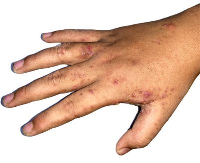 Scrabic Lotion - শিশুদের চুলকানি ধ্বংসকারী লোশন [ Indian ]_img_8