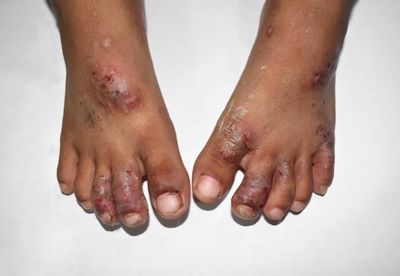 Scrabic Lotion - শিশুদের চুলকানি ধ্বংসকারী লোশন [ Indian ]_img_7