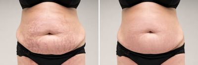Anti Stretch Mark Cream [ মাতৃত্বের দাগ চিকিৎসায় ]_img_1
