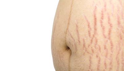 Anti Stretch Mark Cream [ মাতৃত্বের দাগ চিকিৎসায় ]_img_3