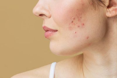 Acnetoin Plus [ Indian ] ব্রণের জীবানু ধ্বংসকারী_img_3