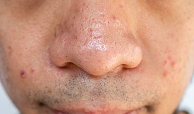 Acnetoin Plus [ Indian ] ব্রণের জীবানু ধ্বংসকারী_img_5