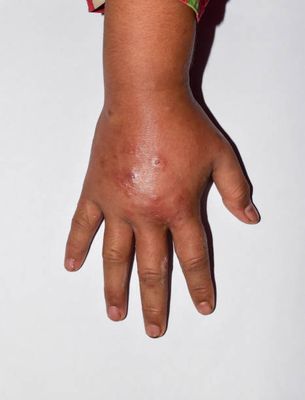 Permefit Lotion [ শক্তিশালী পারমেথ্রিন লোশন ]_img_3