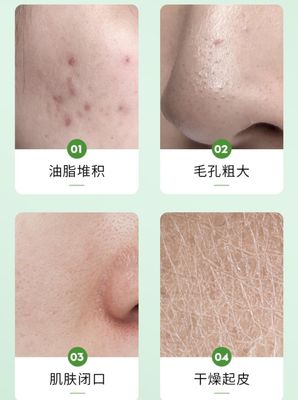 Aloe vera gel skin natural moisturizing lotion facial acne aloe vera gel_img_2