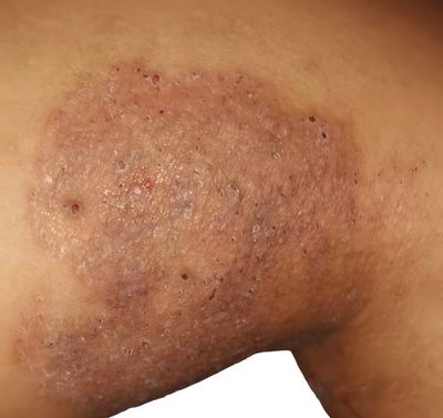 Ketosclap Soap [ Indian ] শক্তিশালী এন্টিফাংগাল_img_4