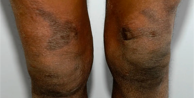Clop G Cream [ একজিমা, দাগ চিকিৎসায় ]_img_5
