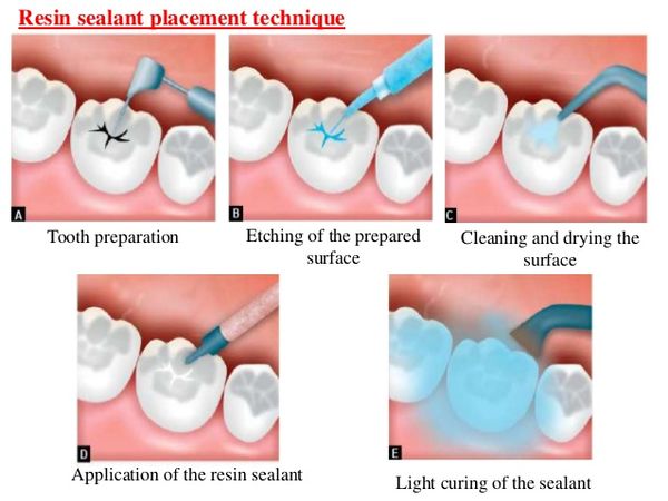 pits and fissure sealant
